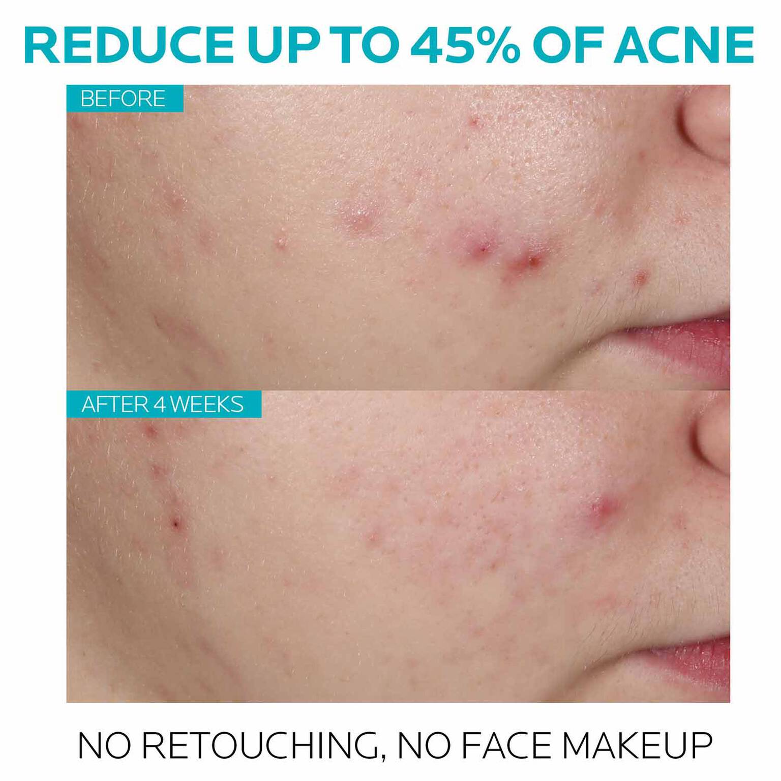effaclar-salicylic-acid-acne-treatment-serum-y8 7_EffaclarSerum_After-45-days.jpg